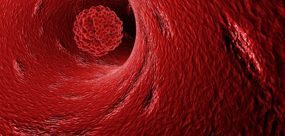 Blood Clots in Cancer Patients May be Caused by